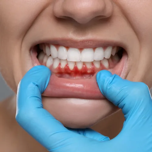 Diş Eti Tedavileri (Periodontoloji)