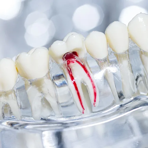 Kanal Tedavisi (Endodonti)